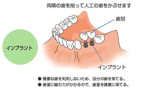 インプラント