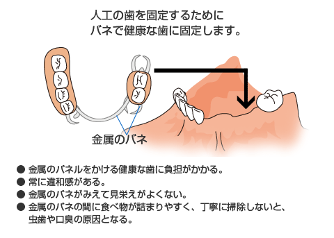 奥歯を含めて複数の歯を失った場合