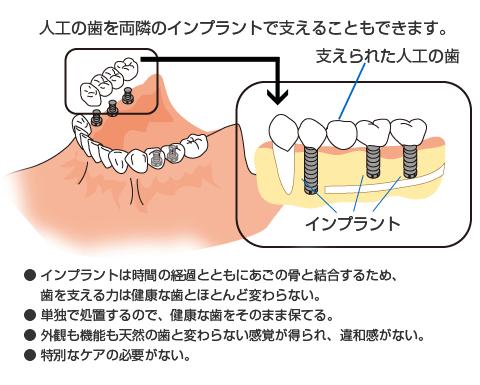 奥歯を含めて複数の歯を失った場合