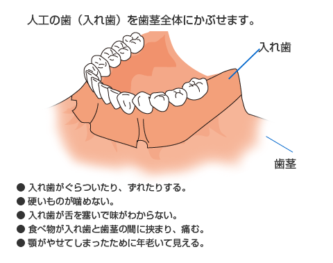 全ての歯を失った場合