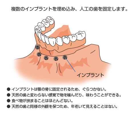 全ての歯を失った場合